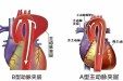 学科建设 | 医院介入医学科独立完成急诊主动脉夹层覆膜支架隔绝术
