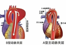 学科建设 | 医院介入医学科独立完成急诊主动脉夹层覆膜支架隔绝术