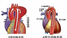 学科建设 | 医院介入医学科独立完成急诊主动脉夹层覆膜支架隔绝术