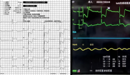 以 “三抓三促” 强担当 | 市一院成功救治高龄心梗休克患者——清醒 ECMO 下联合PCI救治创生命奇迹