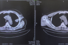 学科建设 | 白银市第一人民医院介入医学科完成首例肺恶性肿瘤氩氦刀冷冻消融术