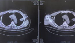 学科建设 | 白银市第一人民医院介入医学科完成首例肺恶性肿瘤氩氦刀冷冻消融术